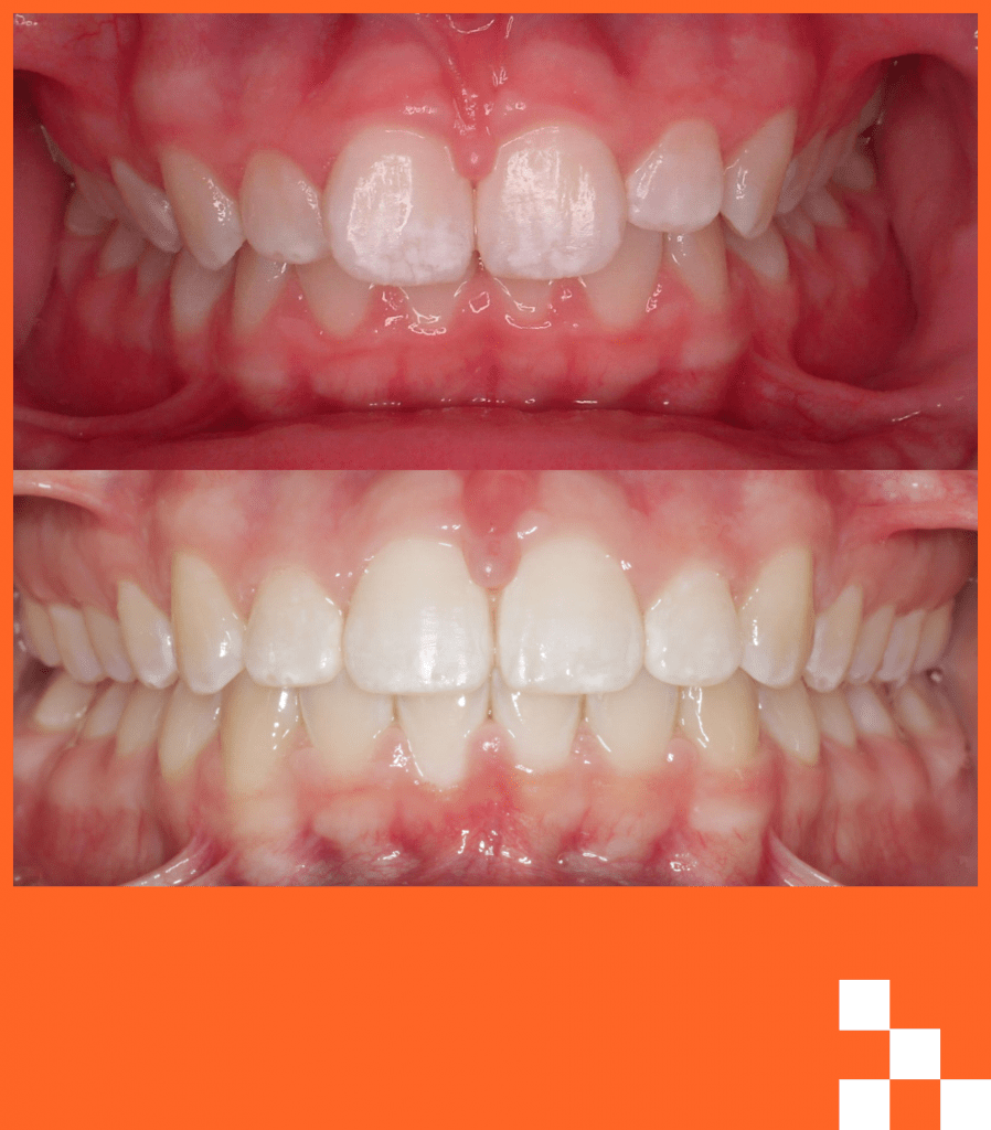 rebsch before & after